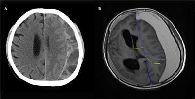 Establishment and validation of a prediction model for self-absorption probability of chronic subdural hematoma